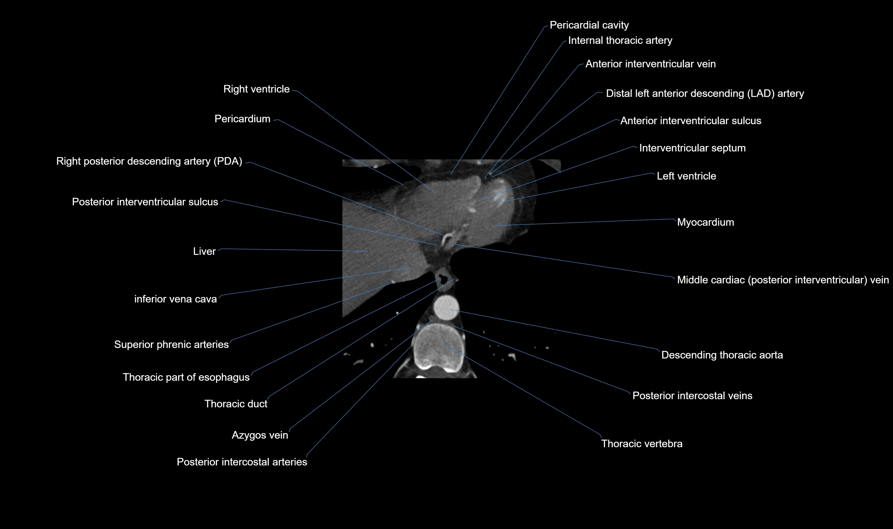 CT heart (coronary angiogram) axial view cross sectional anatomy labelled radiology image-00063.webp